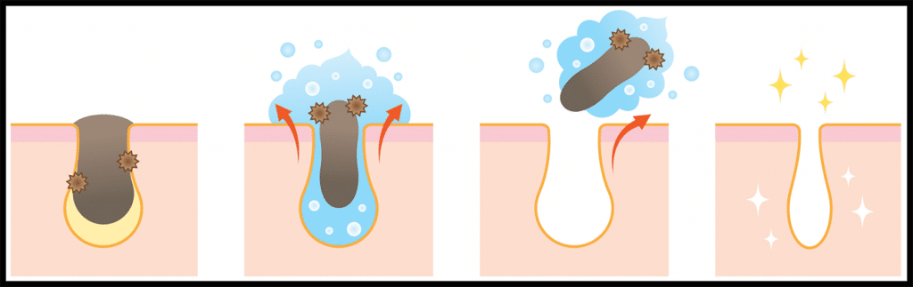 blackhead-removal-using-cleansers-min2 blackhead-removal-using-cleansers-min2